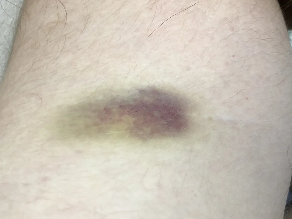 Ett blåmärke på armen som är blålila i mitten och gulgrönt i kanten
