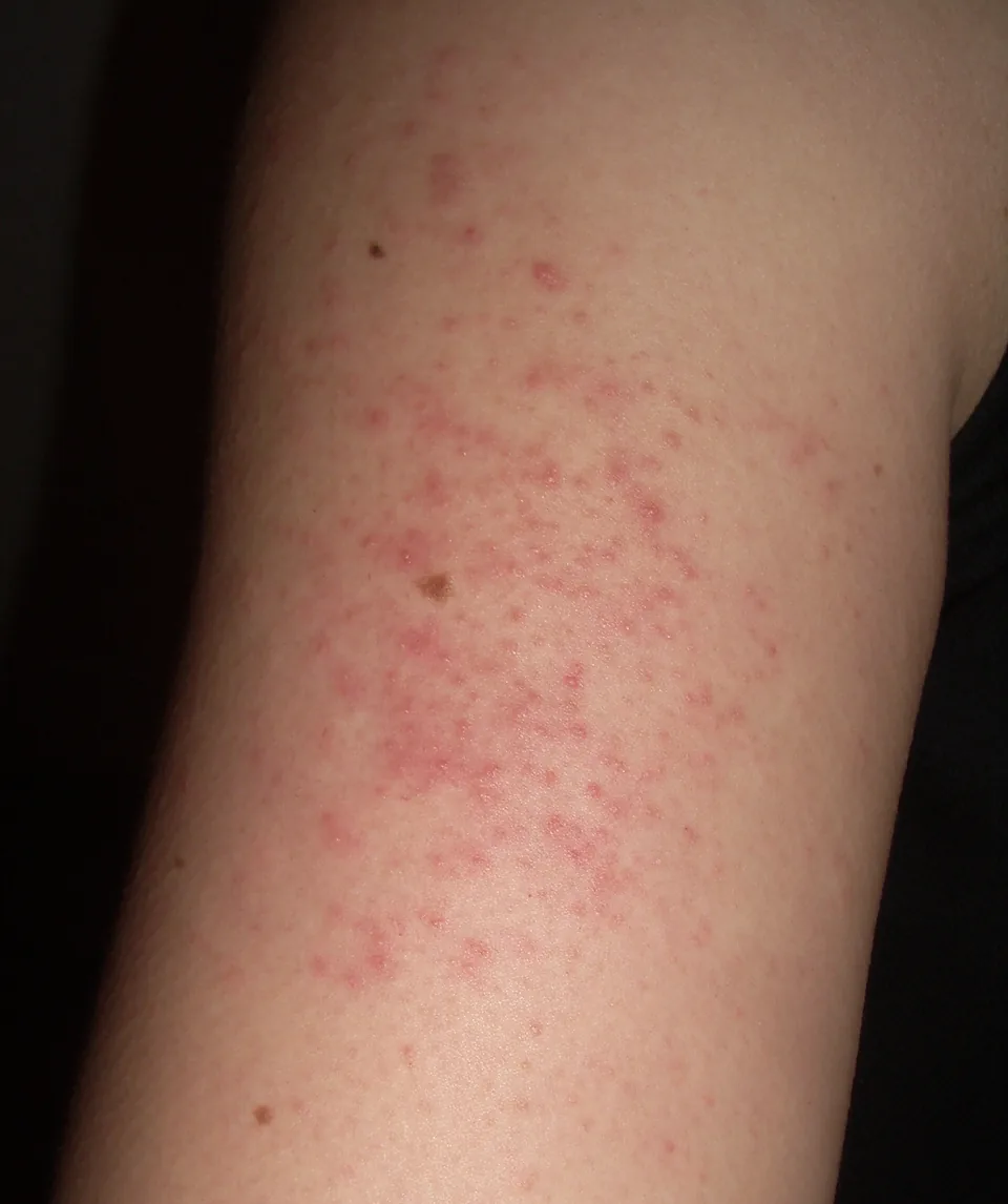 Små röda knottror kring hårsäckarna på en överarm (keratosis pilaris)