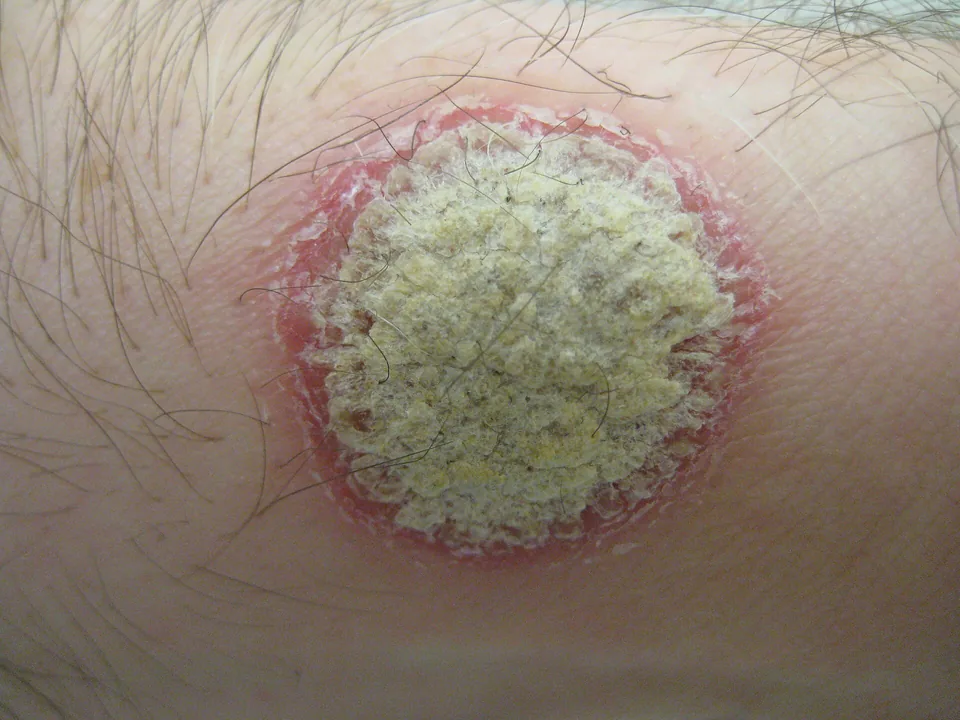 En rund psoriasisplack med röd kant och tjocka fjäll